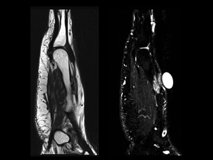 Figure 3 for case Malignant myoepithelial tumour of soft tissue